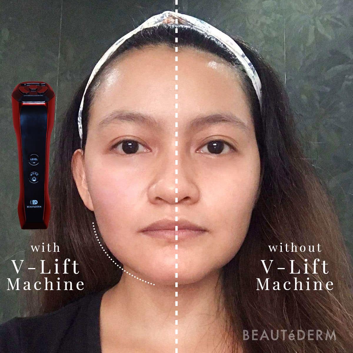 Buy 1 Take 1 Beautederm VLift RF Machine